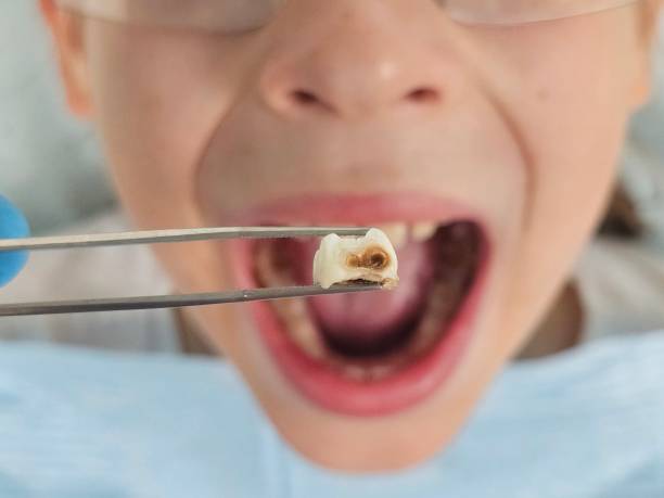 Best Emergency Dental Care for Abscessed Tooth in Crugers, NY
